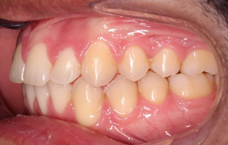 Left Side Bite - After Treatment