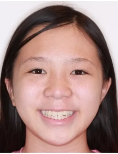 Before Clear Aligners treatment - Case 74380