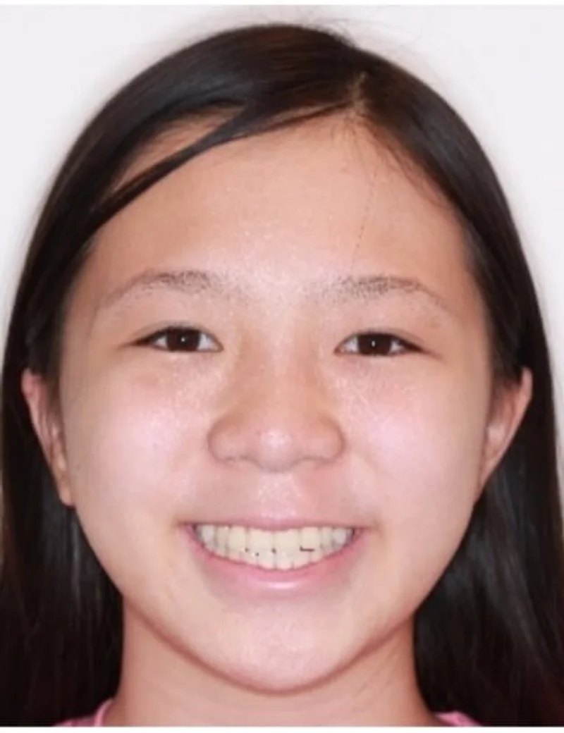 Facial Smiling - Before Treatment