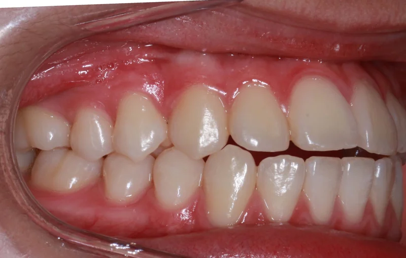 Right Side Bite - Before Treatment