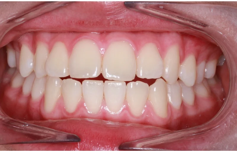 Center Bite - Before Treatment