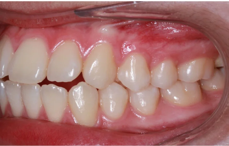 Left Side Bite - Before Treatment