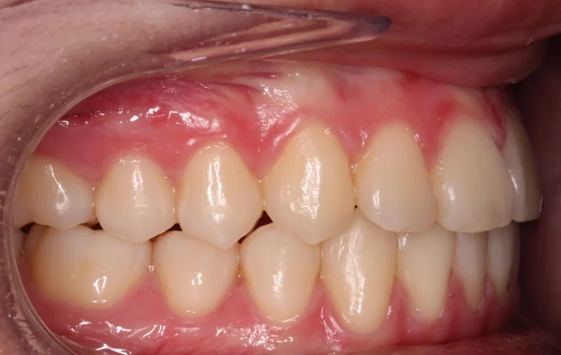 Right Side Bite - After Treatment