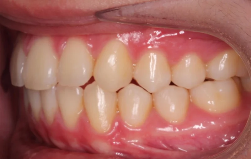 Left Side Bite - After Treatment
