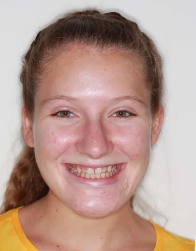 Before Clear Aligners treatment - Case 74384