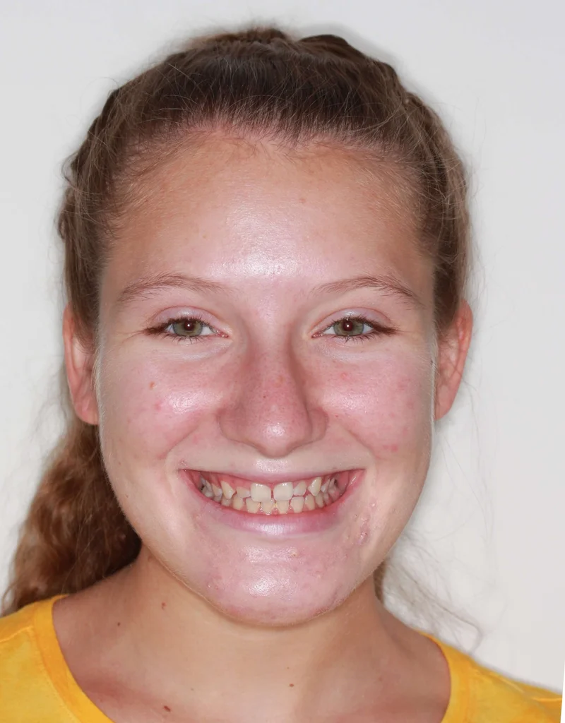 Facial Smiling - Before Treatment