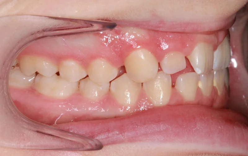 Right Side Bite - Before Treatment