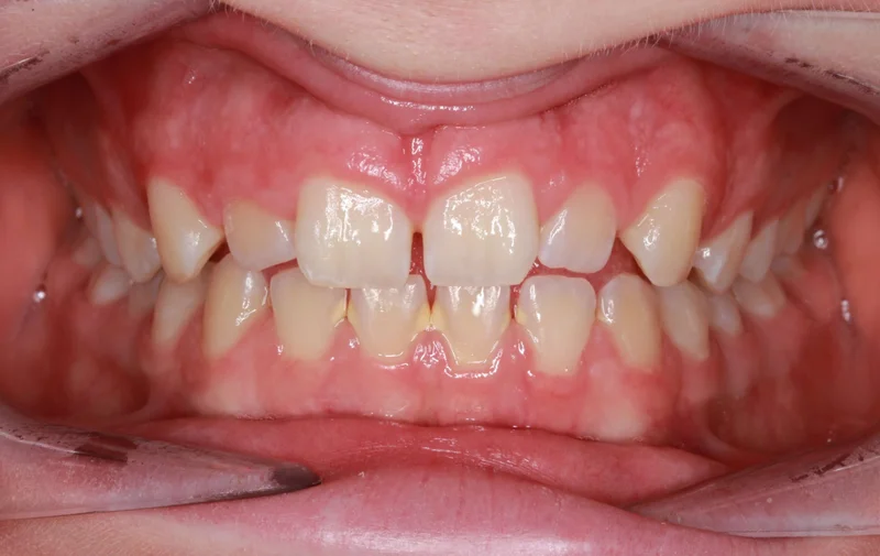 Center Bite - Before Treatment