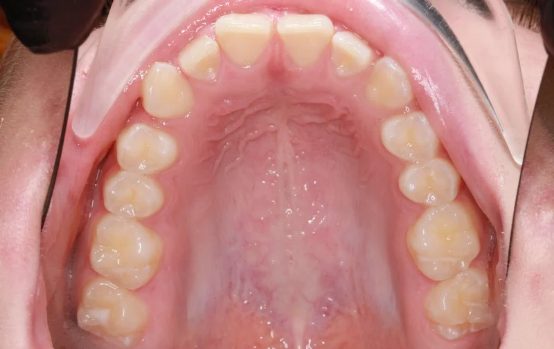 Upper Arch - Before Treatment