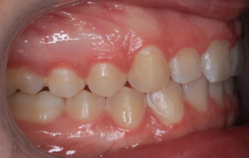 Right Side Bite - After Treatment