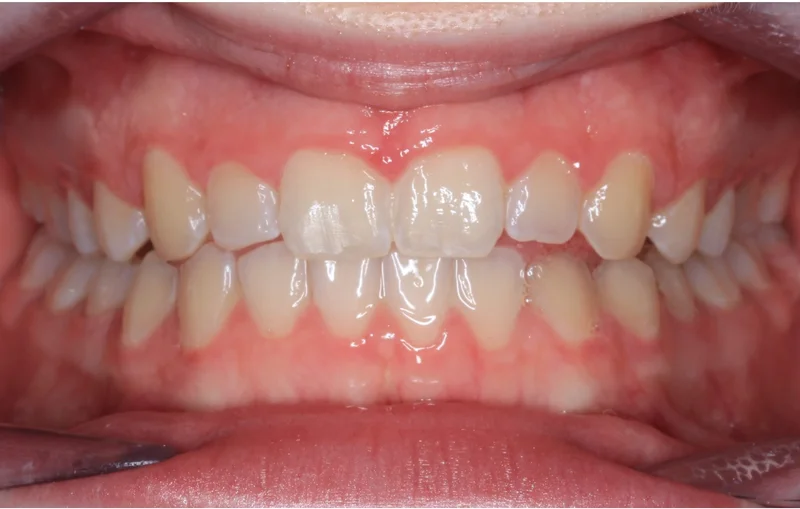 Center Bite - After Treatment