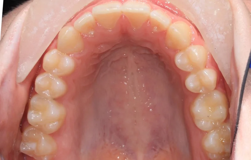 Upper Arch - After Treatment