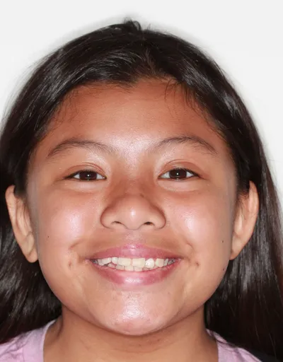 Before Metal Braces treatment - Case 59660