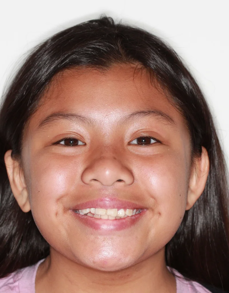 Facial Smiling - Before Treatment