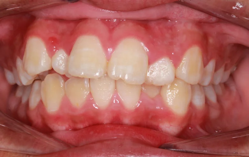Center Bite - Before Treatment