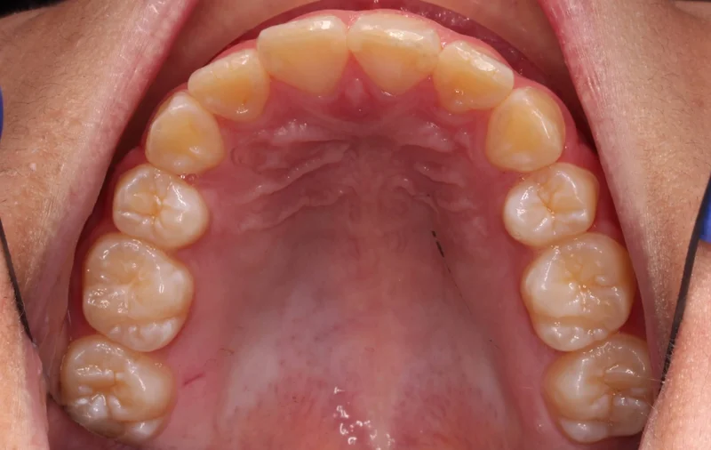 Upper Arch - After Treatment