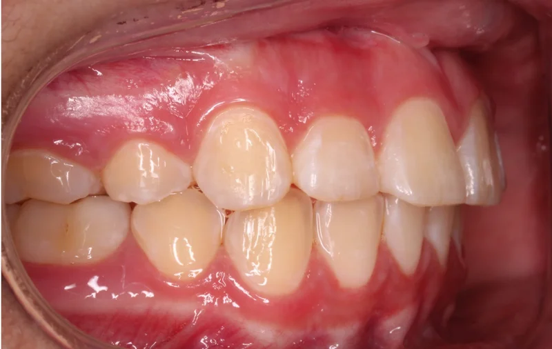Right Side Bite - After Treatment
