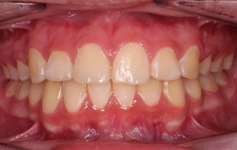 Center Bite - After Treatment