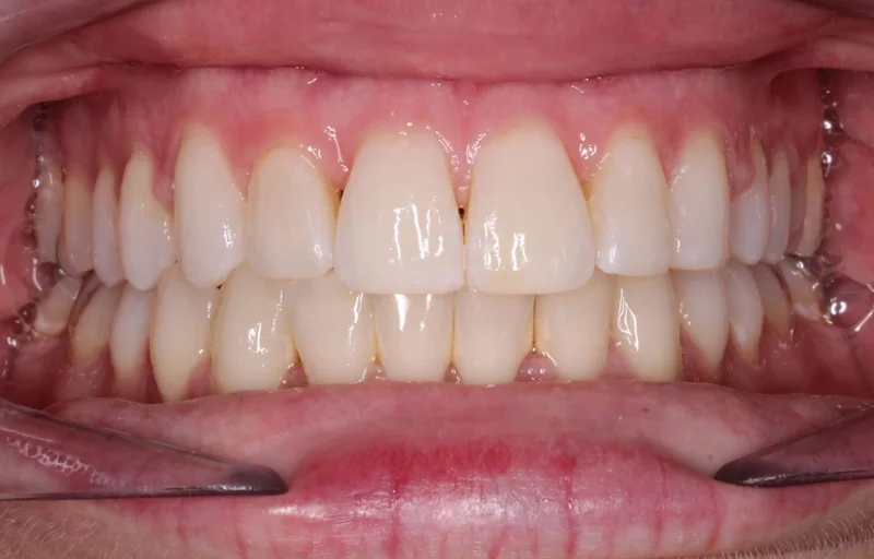 Center Bite - After Treatment