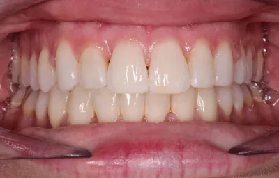 After Metal Braces treatment - Case 76038