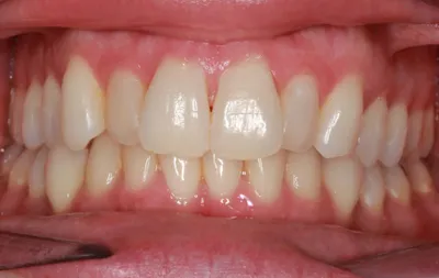 Before Metal Braces treatment - Case 76038