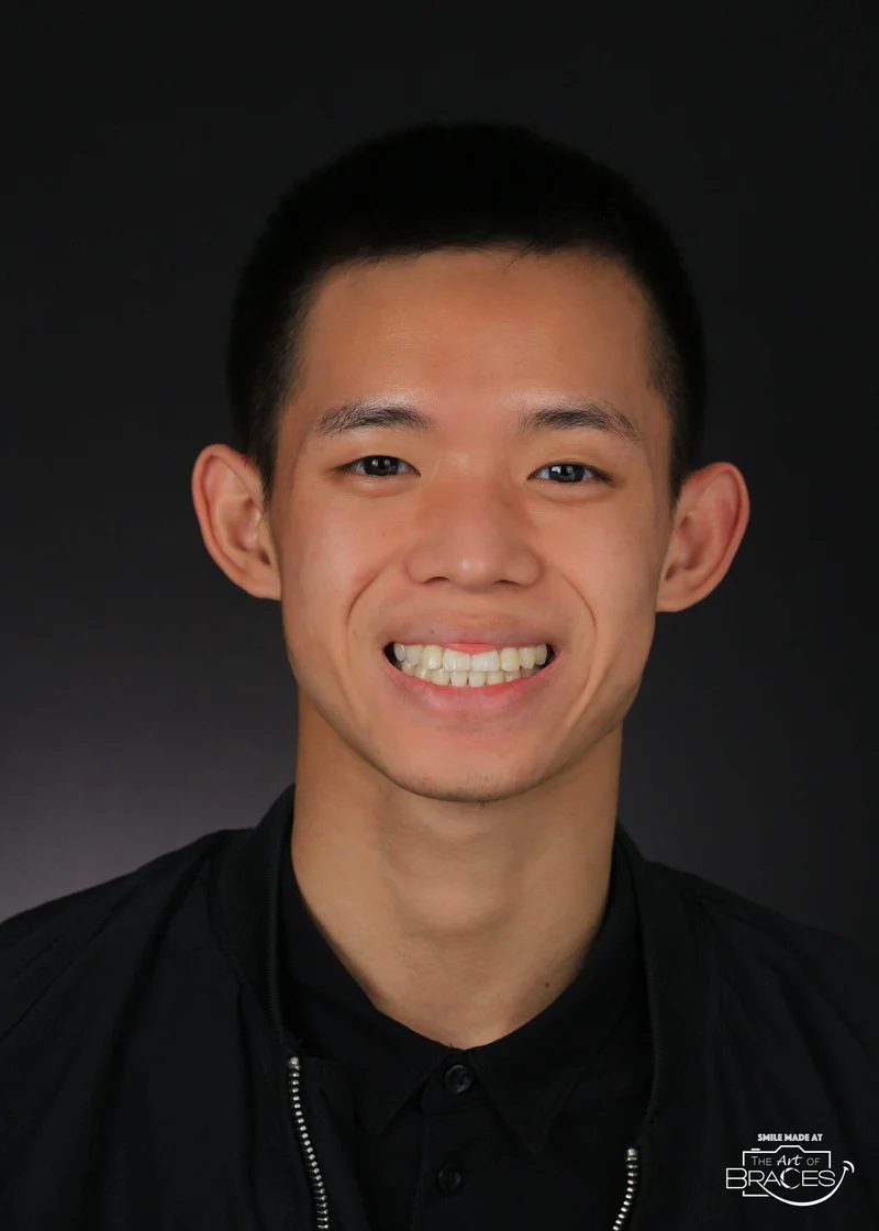 Facial Smiling - After Treatment