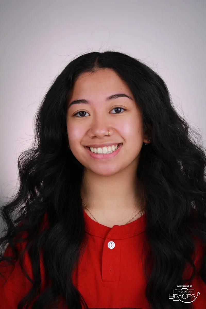 Facial Smiling - After Treatment