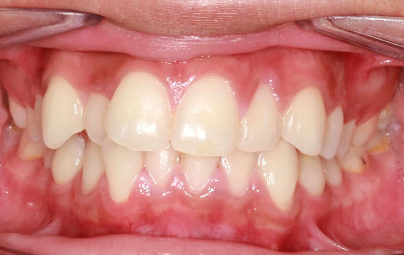 Center Smile - Before Treatment