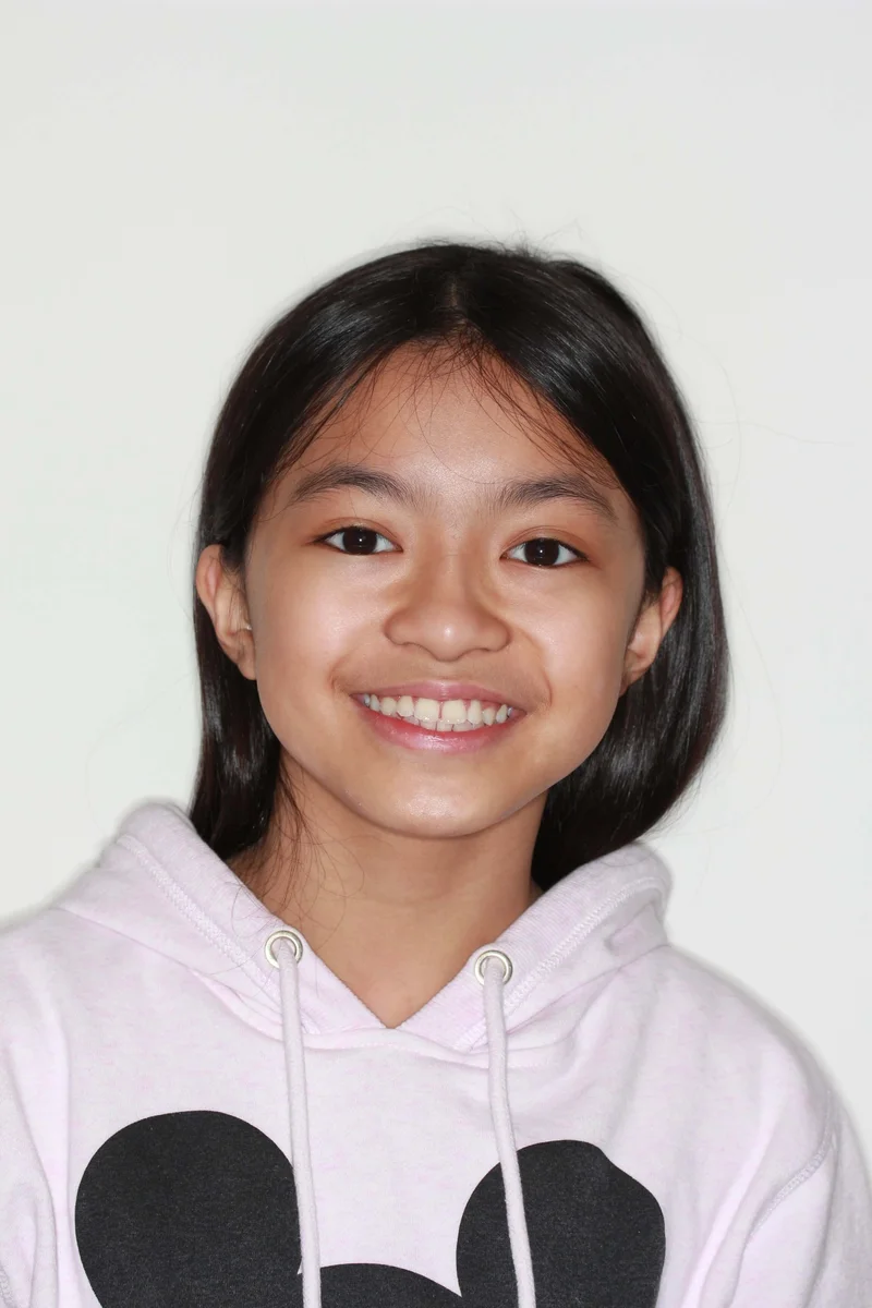 Facial Smiling - Before Treatment