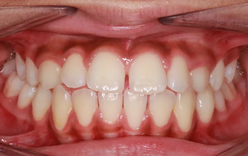Center Bite - Before Treatment