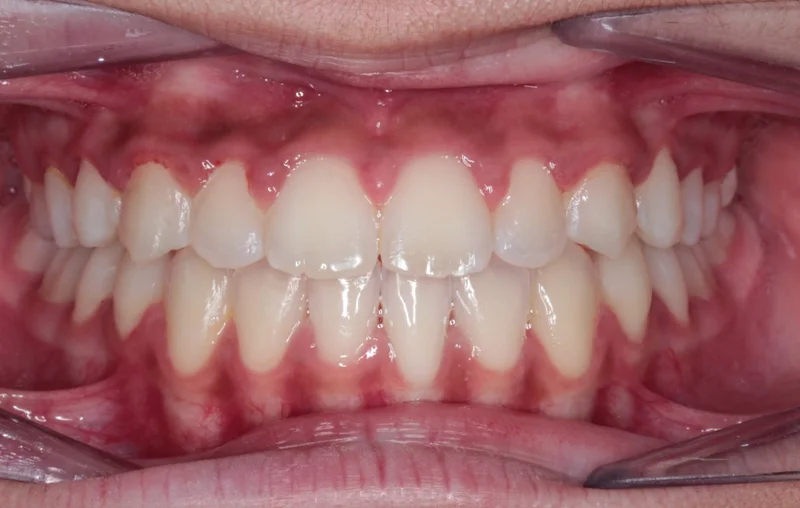 Center Bite - After Treatment
