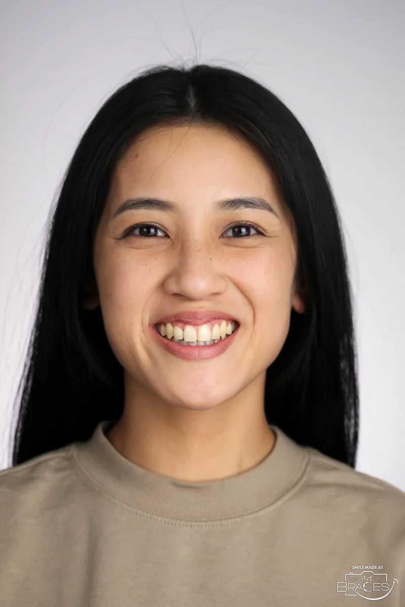 Facial Smiling - After Treatment