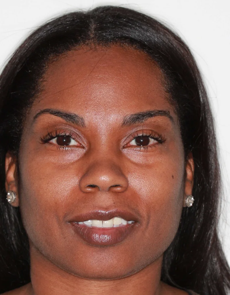 Facial Smiling - Before Treatment