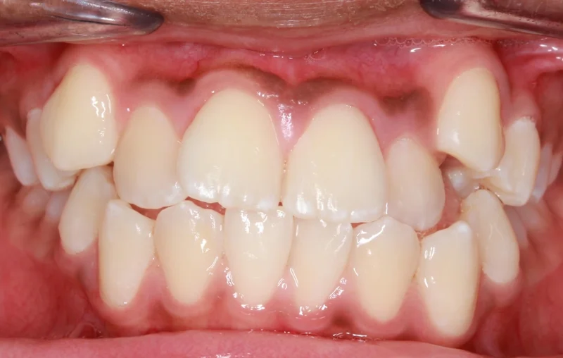 Center Bite - Before Treatment