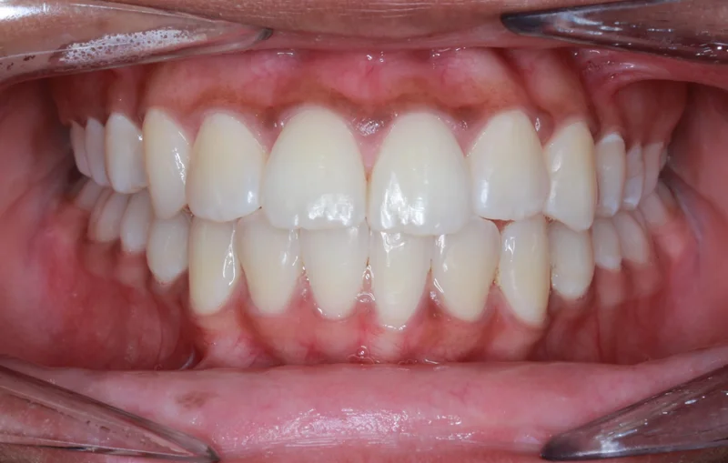 Center Bite - After Treatment