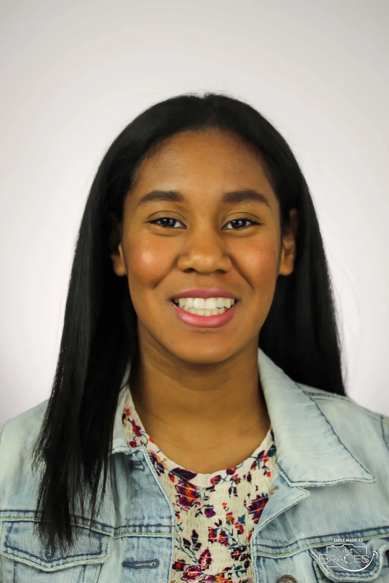 Facial Smiling - After Treatment