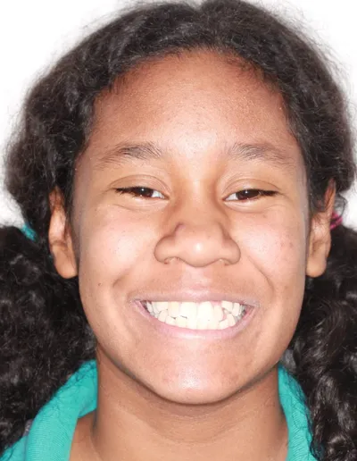 Before Metal Braces treatment - Case 54960