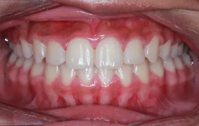 After Metal Braces treatment - Case 64186
