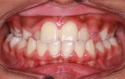 Before Metal Braces treatment - Case 64186