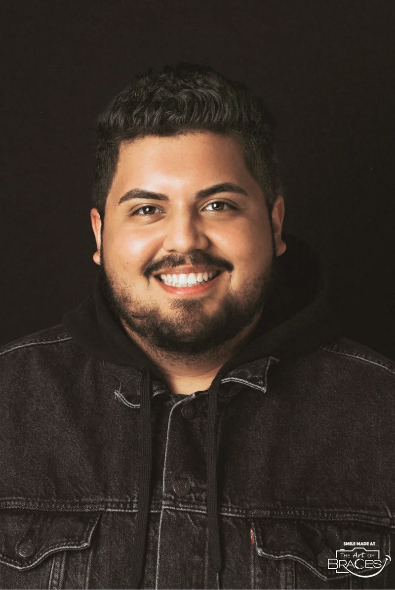 Facial Smiling - After Treatment