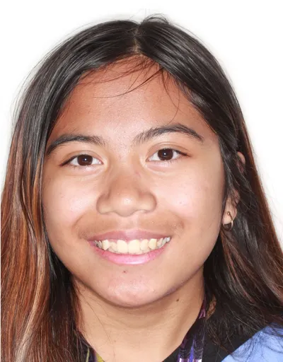 Before Carriere Correction Appliance treatment - Case 78304