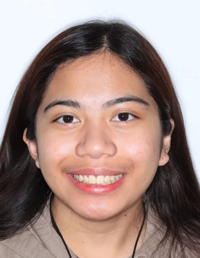 After Carriere Correction Appliance treatment - Case 78304