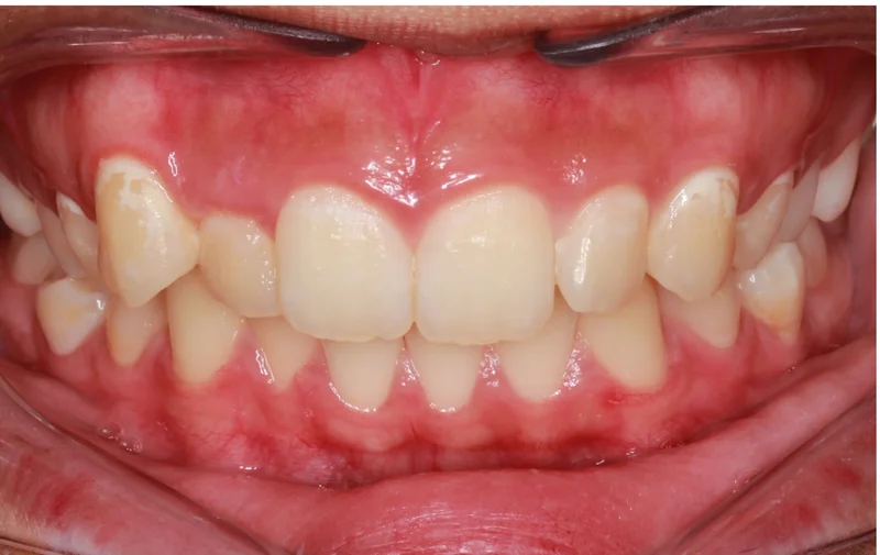 Center Bite - Before Treatment