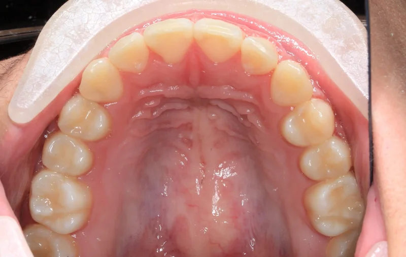 Upper Occlusal - After Treatment
