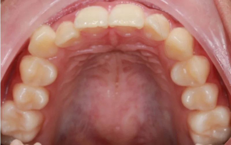 Upper Occlusal - Before Treatment