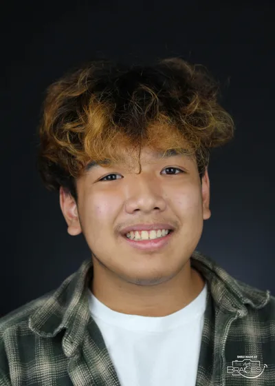 After Metal Braces treatment - Case 78428