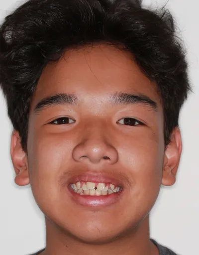 Before Metal Braces treatment - Case 78428