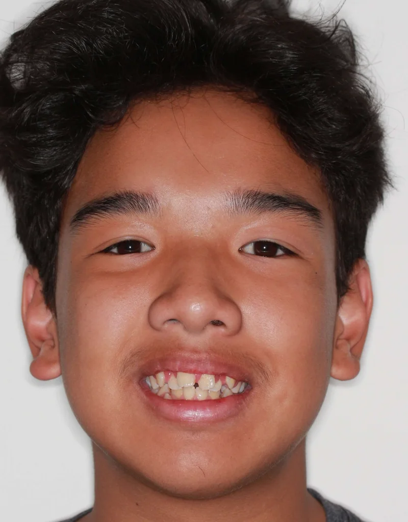 Facial Smiling - Before Treatment