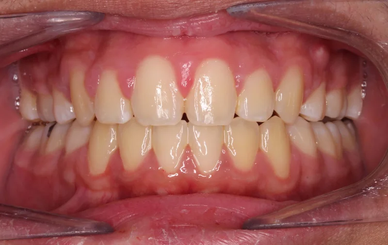 Center Bite - After Treatment