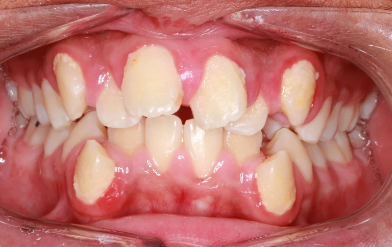Center Bite - Before Treatment